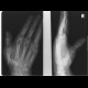 Bennett's fracture of the right hand: X-ray - Plain radiograph